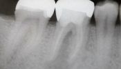 Zahn mit Glasfaserstift im ml- Kanal und apikaler Parodontitis