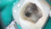 Mesiale Kanäle nach chemomechanischer Aufbereitung