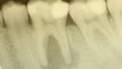 Zahn 36 mit großer apikaler Aufhellung