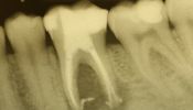 Zahn nach Wurzelfüllung- orthoradial