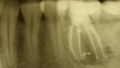 Zahn nach Wurzelfüllung- mesialexentrisch
